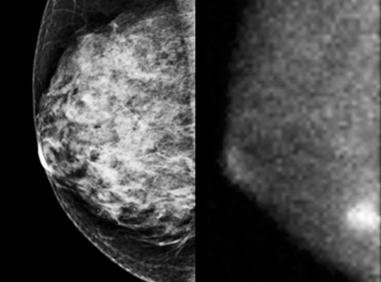 A tumor hidden behind dense tissue in a traditional mammogram (left) appears as a bright spot in a gamma-ray mammogram (right).