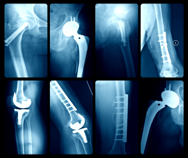 Photo of X-Ray Apps Artificial Joints