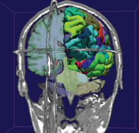 3D Slicer visualization of a brain