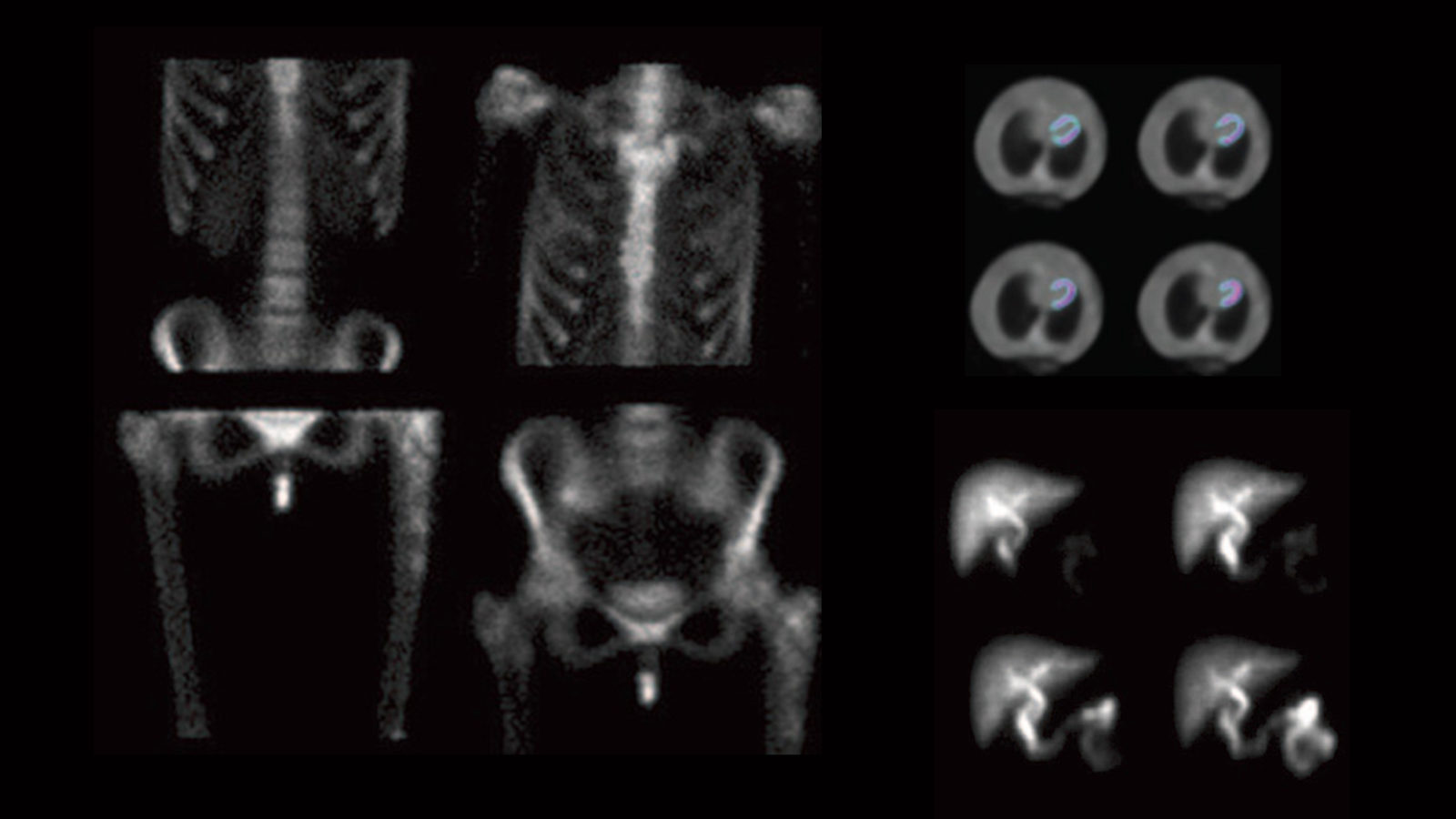 Making the portable gamma camera symmetry magazine
